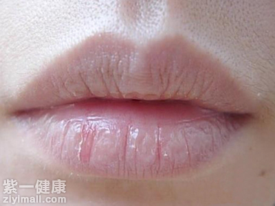 夏天嘴唇干裂是什么原因 多为四大因素引起